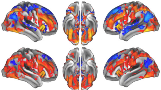 6 brains with various colors indicating brain activity